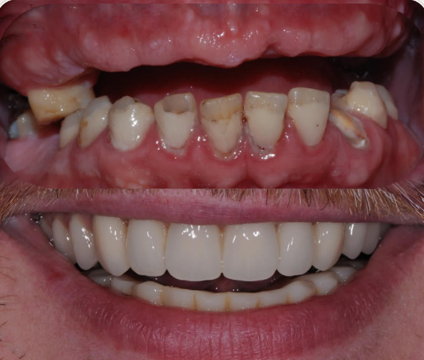 Before and after: failing teeth restored with dental implants at The Peaks Dental