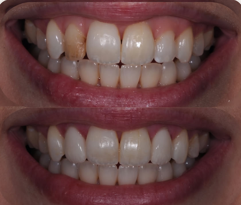 Porcelain veneers before and after at The Peaks Dental