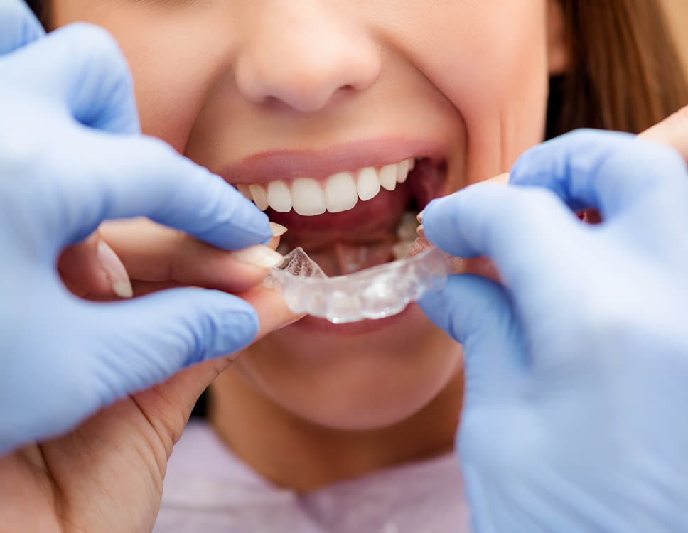 Invisalign Clear Aligners Orthodontics Dental