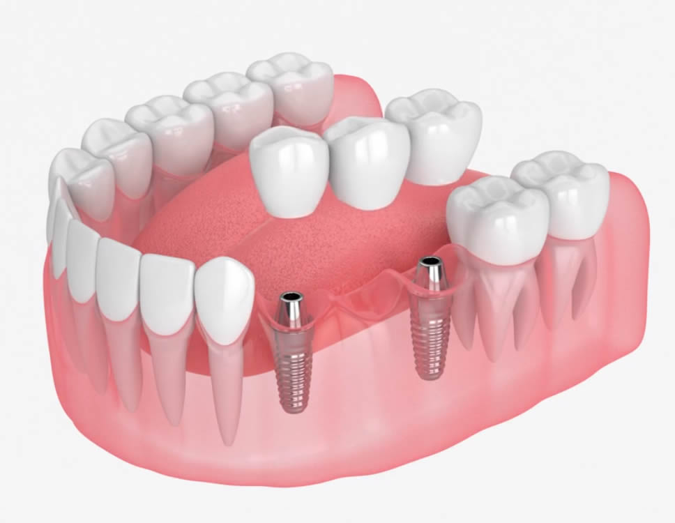 Dental Implants Multiple Teeth Replacement