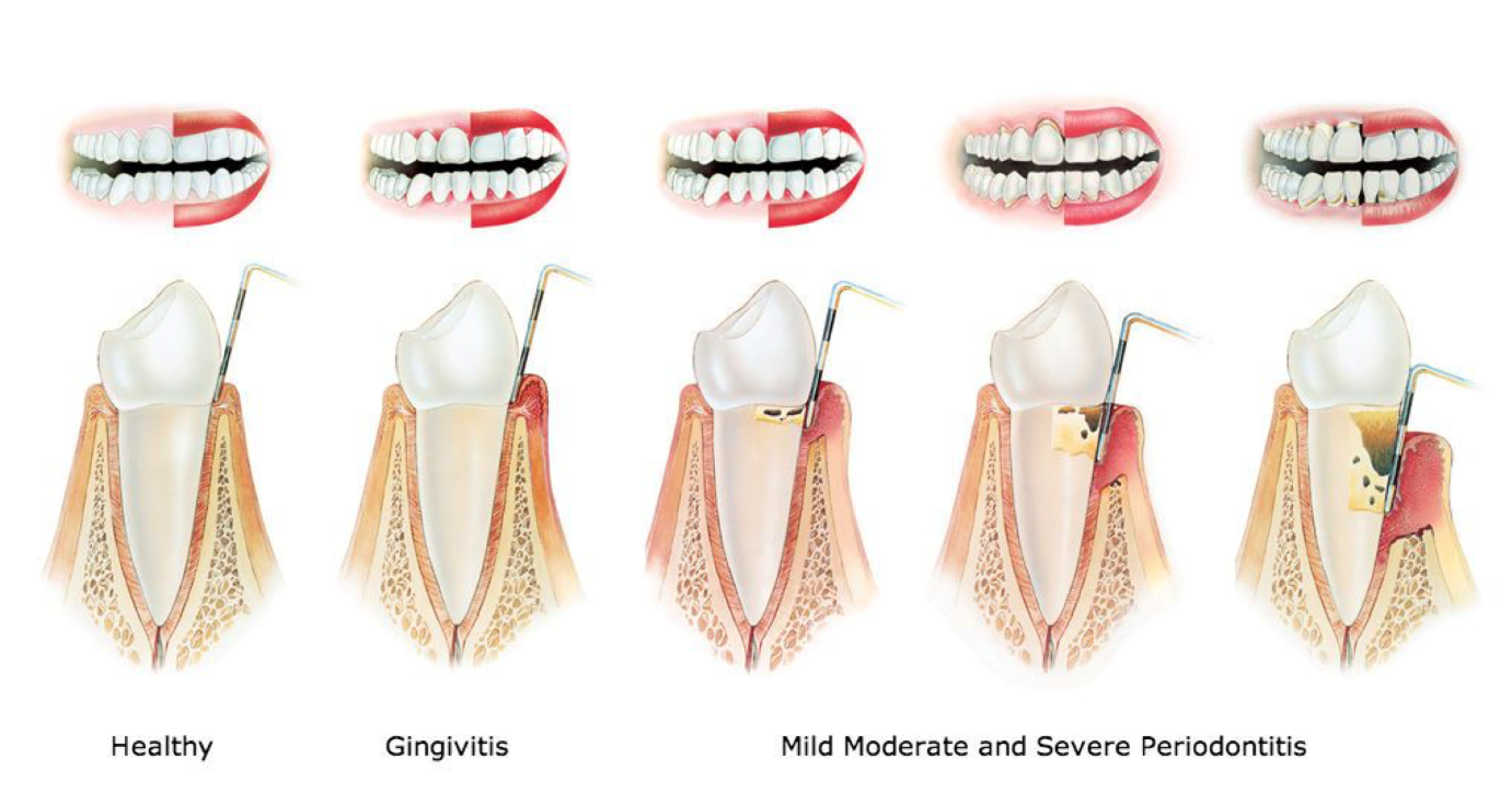 Teeth gums imflation periodontics