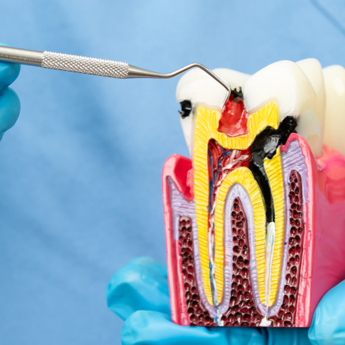 Root canal treatment at The Peaks Dental & Implant Centre